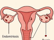 Cuando Dolor Tiene Nombre: Vida Endometriosis