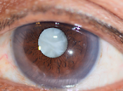 Acerca prevenir cataratas.