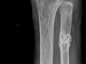 Pseudoartrosis fractura antigua nivel tercio proximal cubito izquierdo