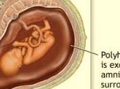 ¿Qué polihidramnios?