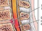Dolor Lumbar Hernia Discal,