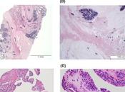 cirugía puede necesaria algunas lesiones mamarias