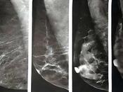 Mamas densas dificultan diagnostico Cáncer