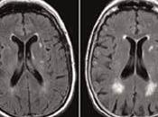 Lesiones materia blanca cerebral estarían asociadas demencia