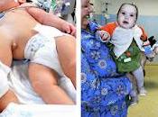 Separan éxito siamesas unidas abdomen hígado