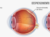 destellos puntos flotando puede indicar separación vítreo desprendimiento retina.